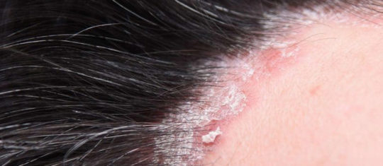 psoriasis